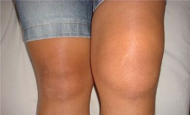Causes of arthrosis of knee joint