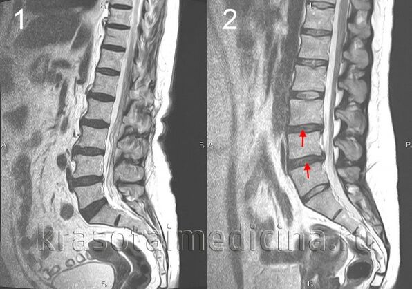 Osteocondrosis of the spine