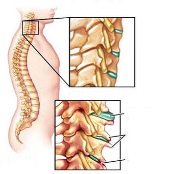 Compared to a healthy and sick vertebra in the neck