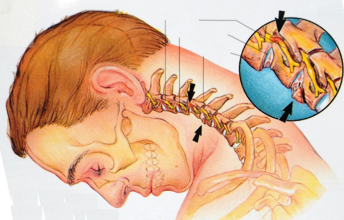 Osteocondrosis of cervical region