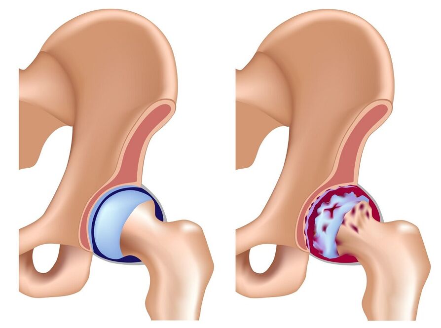 Healthy combination of hip combination and arthrosis