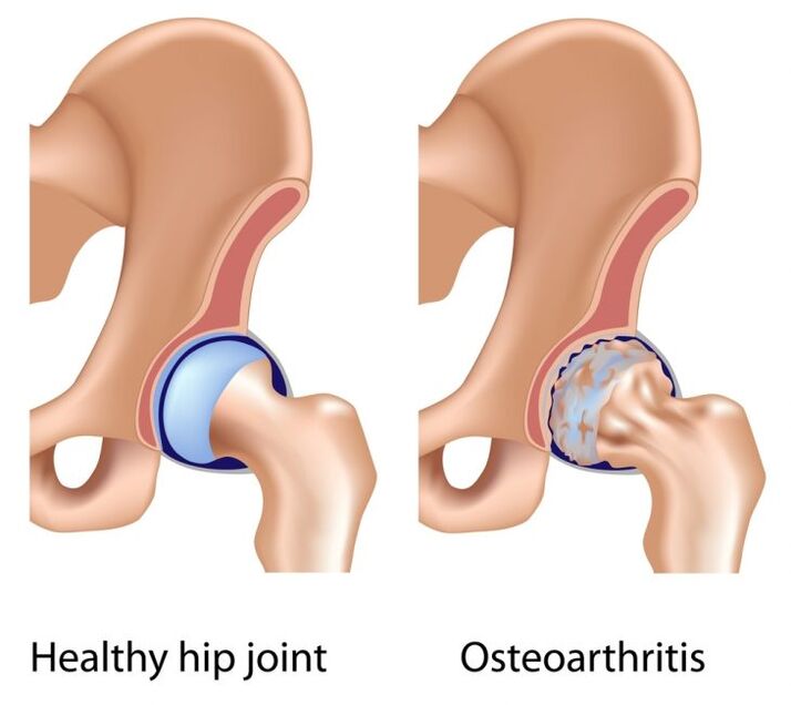 Healthy joint and arthrosis of the hip joint